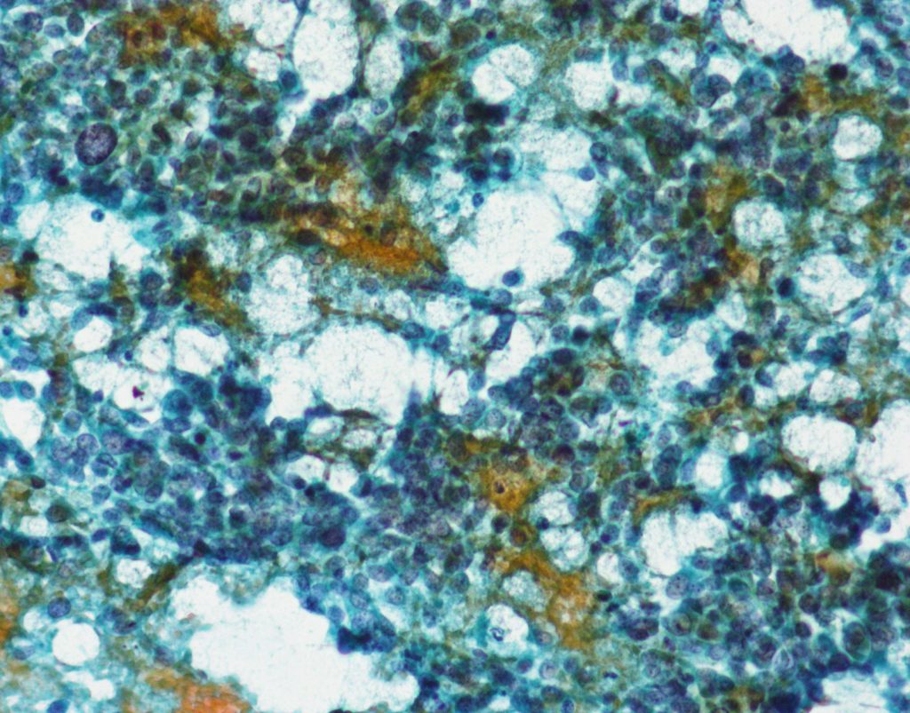 Case 3 | Johns Hopkins Cytopathology Unknown Conference