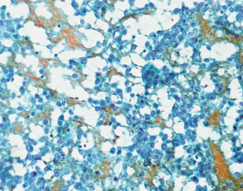 Case 3 | Johns Hopkins Cytopathology Unknown Conference