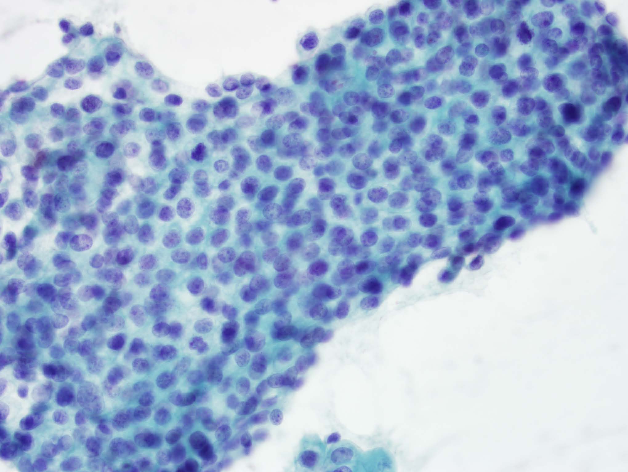 Case 34 | Johns Hopkins Cytopathology Unknown Conference